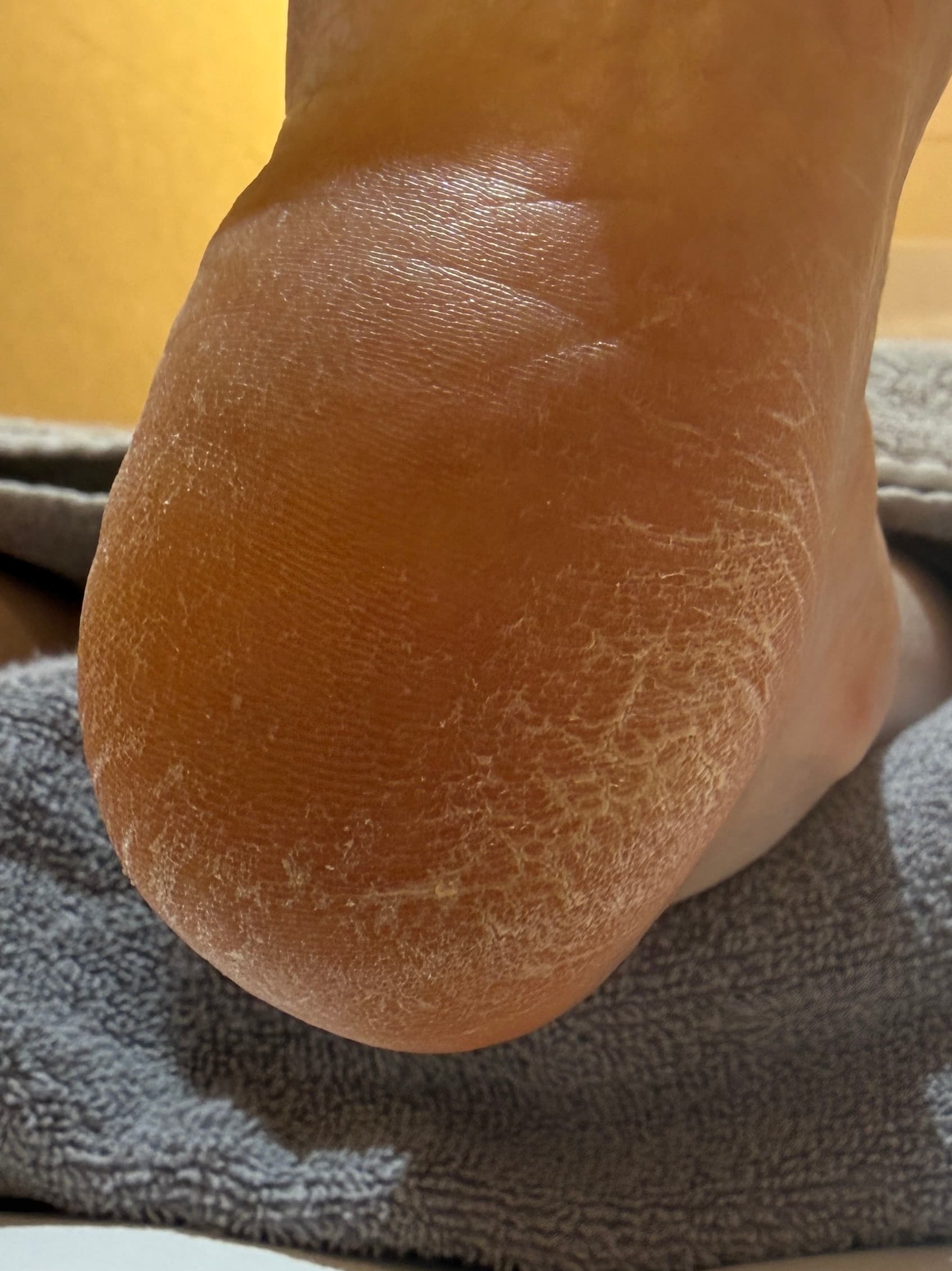 足裏角質ケア Before